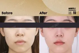 隐形矫正解决“整齐的龅牙”！2年2个月超前完成，效果超出预期图片