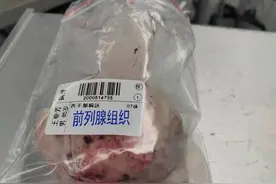 前列腺钬激光剜除手术亲历记图片