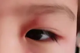 最近，很多人吃退烧药后过敏！医生提醒：这是退烧药常见不良反应图片