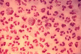 什么是淋病？怎么才能避免染上？图片