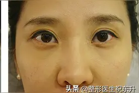 千万别轻易做祛眼袋手术，有些后遗症你接受不了图片