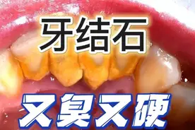 想要消除又臭又厚牙结石？按这3个方法做，手一碰牙结石自动掉！图片