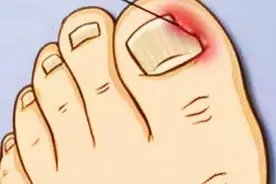 脚趾甲老往肉里钻，一碰还疼？教你小妙招，预防甲沟炎告别疼痛图片