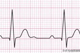 心房颤动及其特征图片