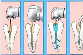 根管治疗后不戴牙冠=这颗牙白“救”了？图片