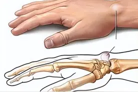 手腕腱鞘炎图片