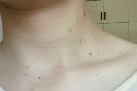 皮肤长“小肉球”是怎么回事，可以抠掉吗？如何处理？一文看懂图片