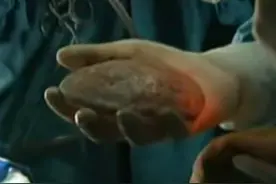 重庆14岁少年做开颅手术，大脑中出现“贝壳”状异物，为啥？图片