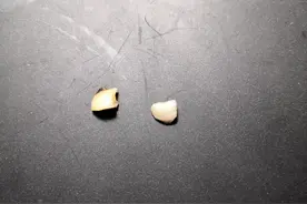 自己拔牙的经历图片