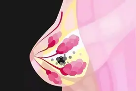 乳腺肿块良性恶性的鉴别方法是什么？图片