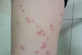 近期高发！绍兴不少小朋友中招，身上长出红疙瘩图片