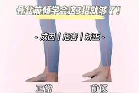 有种“伪翘臀”叫骨盆前倾图片