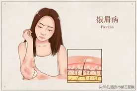 走出“银”影｜正确认识银屑病，不当治疗危害大！图片