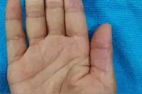 0用药，只做这件事，就缓解多年顽固手湿疹！图片