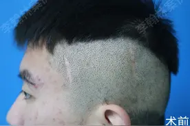 疤痕植发案例图片