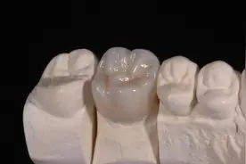 为何医生都推荐全瓷牙冠？难道烤瓷牙冠和金属牙冠就不能用了？图片