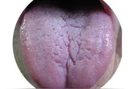 舌头有裂纹？分享4个中成药的方案，教你有效改善裂纹舌图片