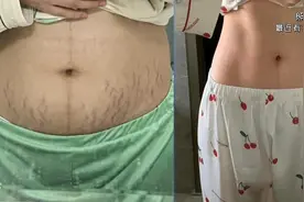 淡化妊娠纹拒交智商税！手把手教你怎么买到有用靠谱的妊娠产品！图片