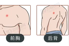 前胸后背长痘痘，是什么原因？简单来讲，可能是没做好这3件事图片