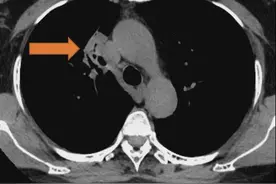 【院庆51周年】胸外科：体检奇妙之旅 | 气管镜下的超声小探头图片