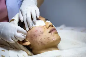 潮健康福利馆 | 祛痘这件事交给它，专攻痤疮粉刺，帮你找回干干净净的脸图片