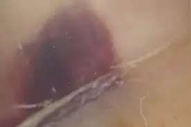 指甲出现黑线、竖纹是病吗？3种易被忽视的甲疾患，小心这种会癌变！图片