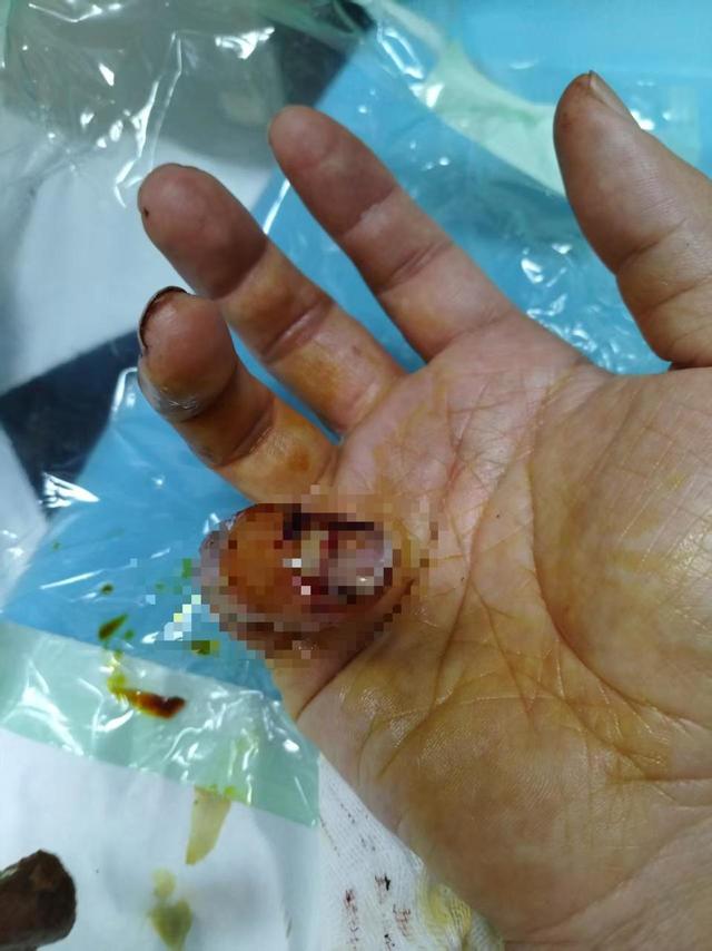 理发店主阻拦城管撕广告，冲突中被对方咬伤手指；兰州警方：将依法调查处置