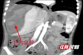 小孩玩滑板摔倒肝脏破裂出血 湖南省儿童医院精准手术成功救治图片