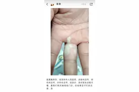 深圳一女子称沾染“化骨水”手指严重受伤，相关医院发声图片