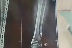 有人摔成粉碎性骨折！“又土又丑”却翻红卖爆，医生紧急提醒图片