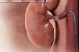 吃了5种降压药血压仍超标？大腿根打个“小孔”就解决了图片