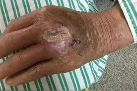 被狗咬了一口，杭州大伯伤口流脓高烧不退！为啥打了狂犬病疫苗仍遭罪？图片