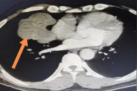 “工作狂”身体不适就医发现长了肿瘤！专家提醒上班族要定期体检图片