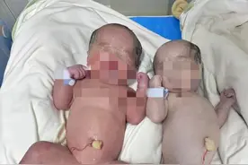 子宫里“抢血液”，双胞胎出生后皮肤一红一白！现场医护人员看了后马上开始抢救图片