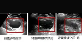 什么是肾囊肿，得了肾囊肿怎么办？图片