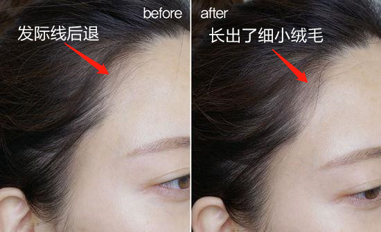 头上扣下来的白泥竟然是螨虫尸体！头痒头屑出油多，用TA就对了