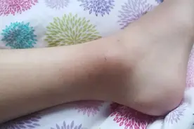 「速看」蚊子叮一口，肿得像“馒头”，真的是蚊子“太毒了”？图片