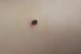 蜱虫钻进2岁宝宝体内后……图片