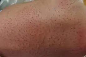 刚满月的宝宝背后长出“猪毛”！只因这个举动图片