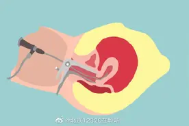 做宫腔镜需要住院吗？图片