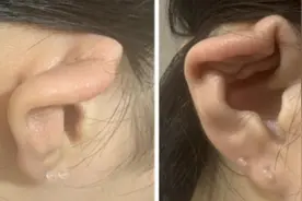 15岁女孩打耳洞引发软骨膜炎导致耳廓畸形，这些禁忌须注意图片