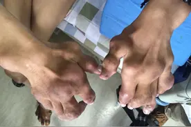 全民关注痛风日丨31岁小伙手脚全“废”，医生提醒：别再被这些观点耽误了图片