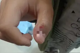 7岁女孩被泰迪咬伤右手 ，狗主人：愿意承担部分费用图片