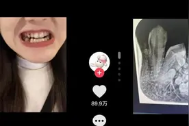 23岁女生缺一颗牙，竟拔出57颗“牙”图片