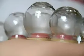火罐拔出水泡？专家告诉你怎么回事图片