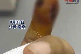 女子拔手指倒刺致骨髓炎住院，当事人：一直在化脓，将进行刮骨手术，专家回应：处理不当会有截肢风险图片