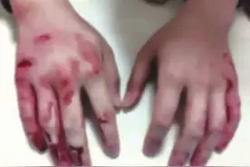 桃江小伙砸车窗救人双手被划破 全网心疼,他却说值图片