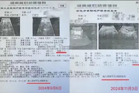 “调皮的生命线” 脐带绕颈5周宝宝在湖南省妇幼保健院平安出生图片