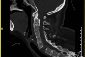 女子颈椎骨折致全身瘫痪，进ICU抢救！这项活动近期热门，紧急提醒图片