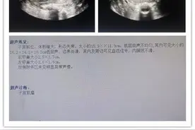 赤峰市第二医院微创摘除一例巨大子宫肌瘤图片